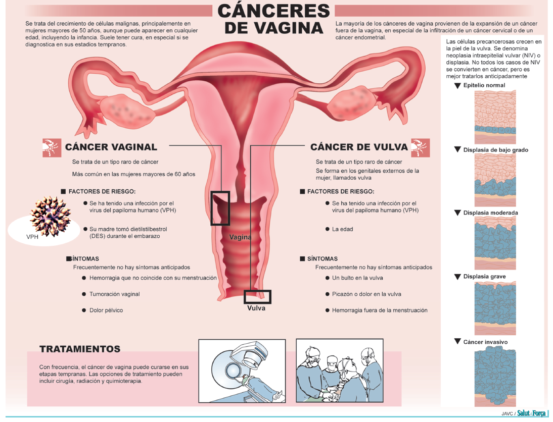 Cancer de vagina y vulva