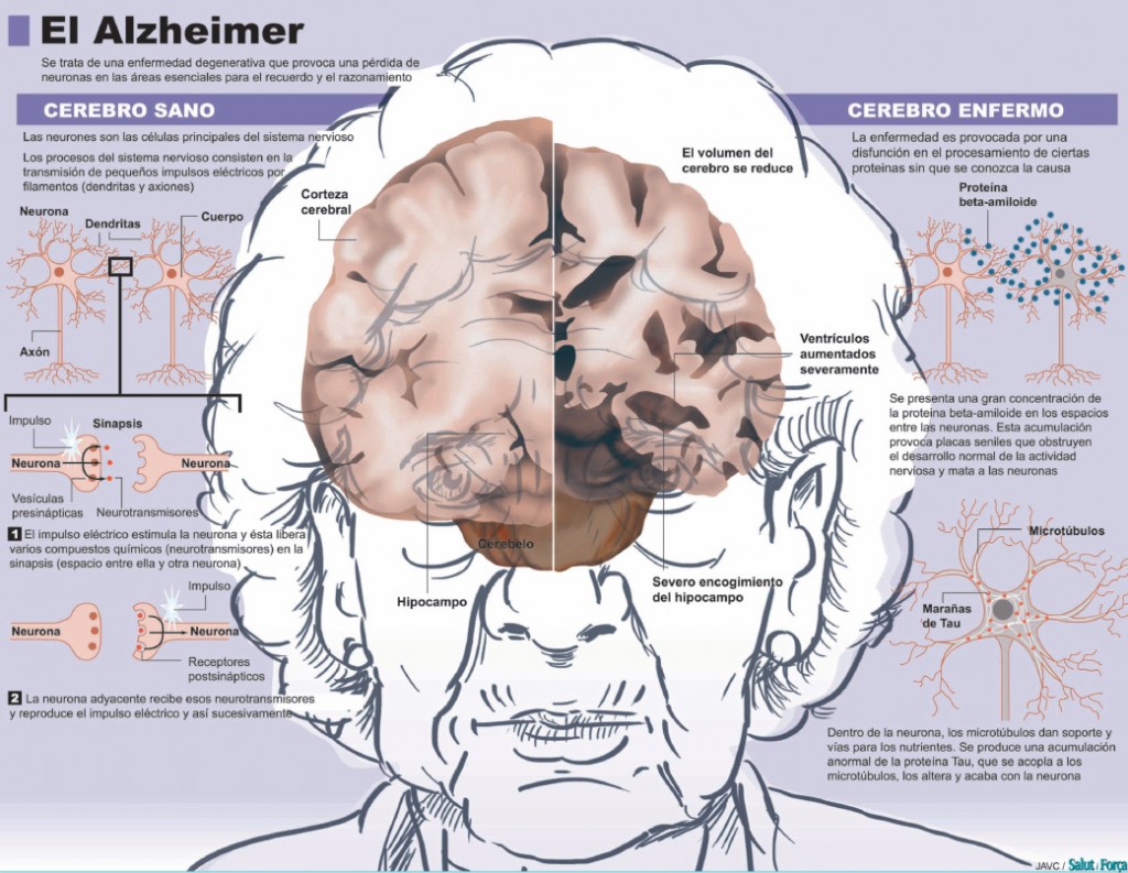 El Alzheimer Vivir Con La Demencia Salud Ediciones 2052