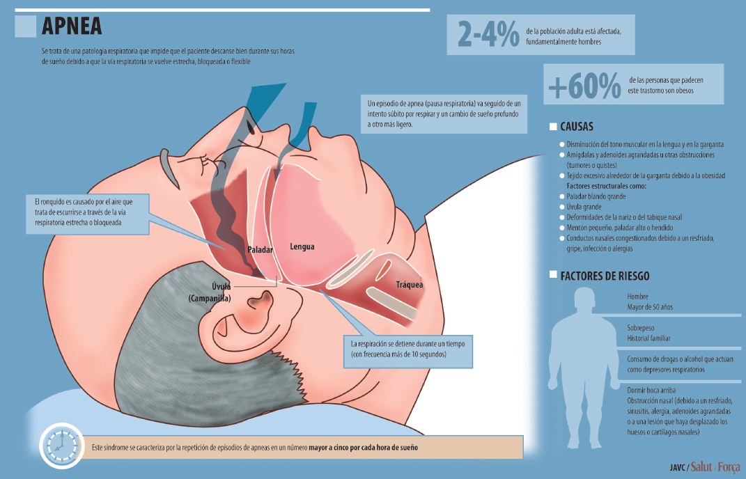 La apnea del sueño favorece el infarto, el ictus y el cáncer